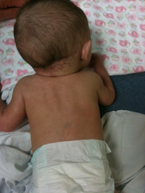 June is scoliosis awareness month