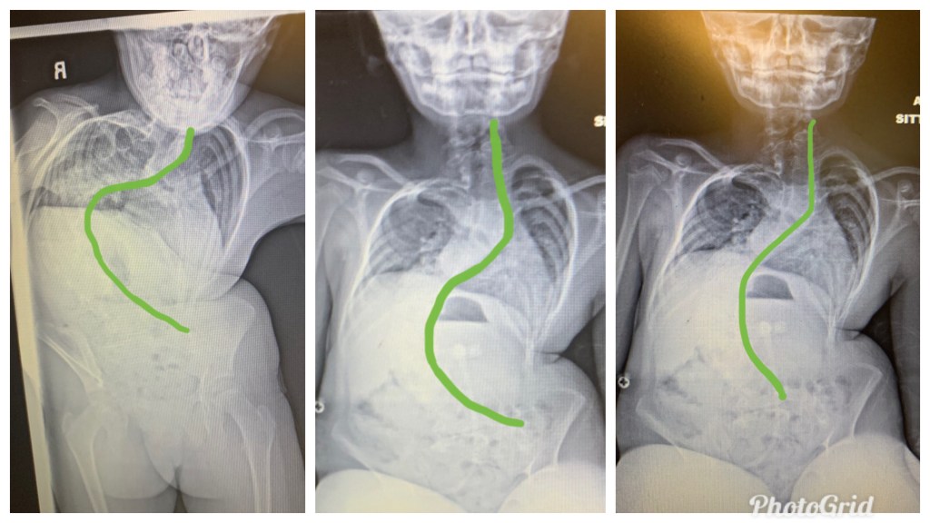 June is Scoliosis Awareness Month