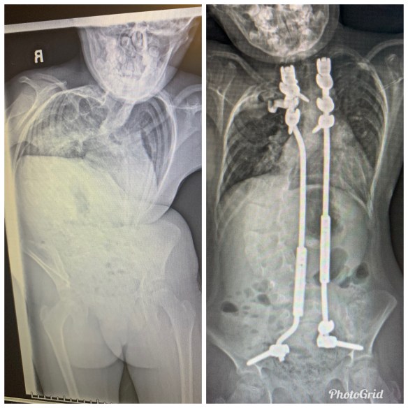 SCOLIOSIS AWARENESS
