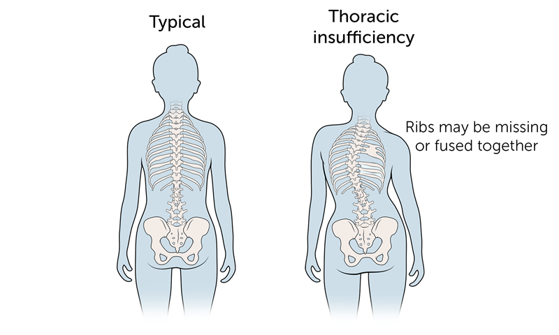Thoracic Insufficiency Syndrome BCH