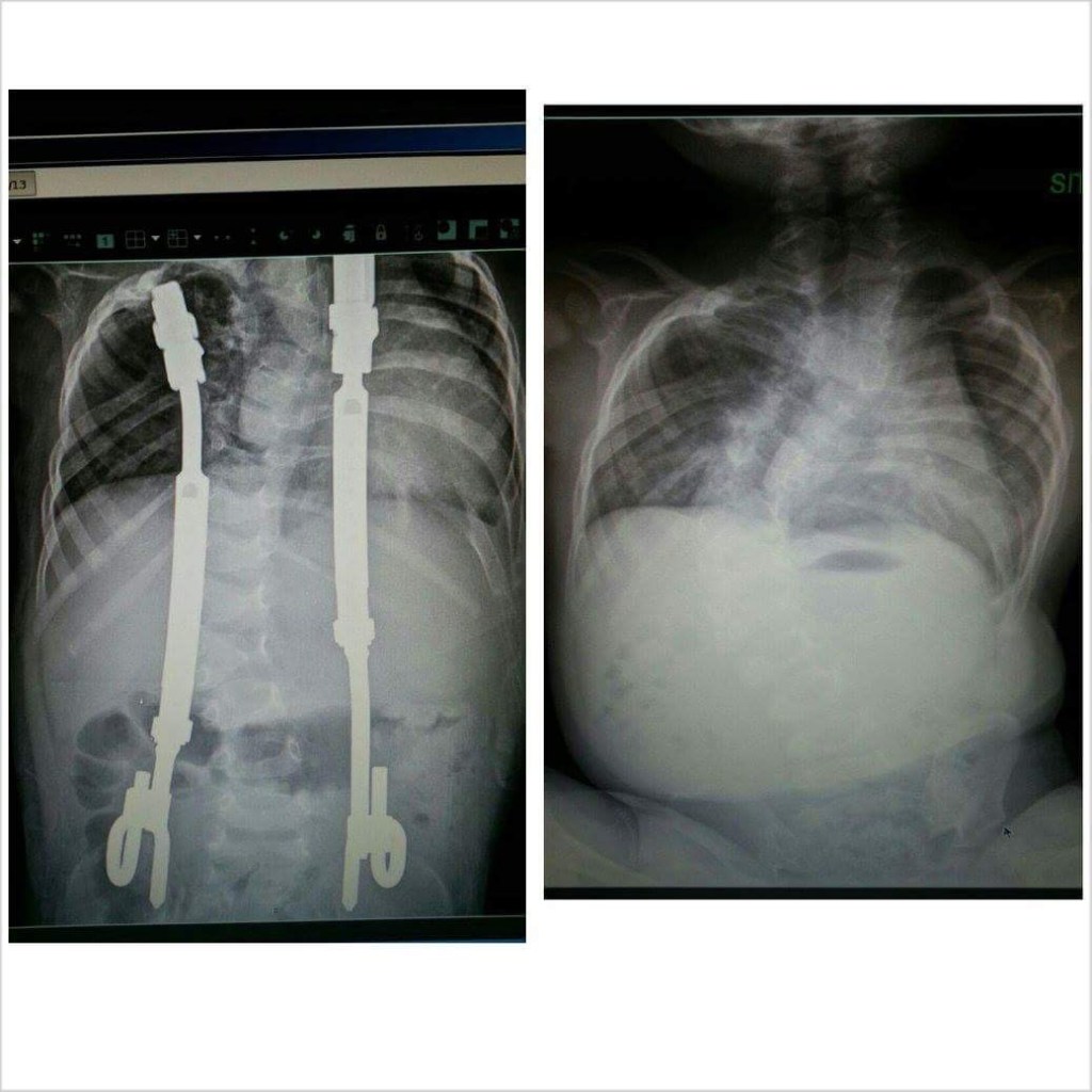 June is scoliosis awareness month