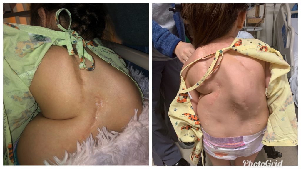 June is Scoliosis Awareness Month